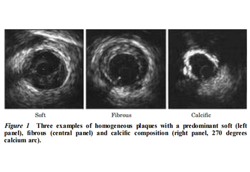 Clinical application and image interpretation in intracoronary ultrasound