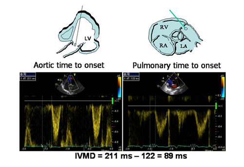 Doppler echocardiography and myocardial dyssynchrony a practical update of old and new ultrasound technologies
