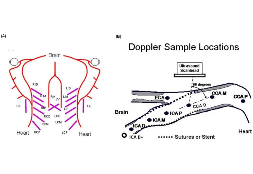Standardized ultrasound evaluation of carotid stenosis for clinical trials University of Washington Ultrasound Reading Center