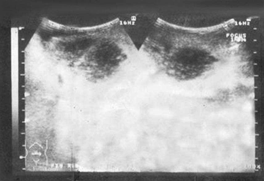 Hepatic Subcapsular Hematoma: Two Neonates With Disparate Presentations