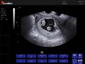   Trans-vaginal Probe-B Mode-Uterus 2