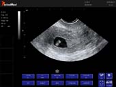   Trans-vaginal Probe-B Mode-Uterus 4