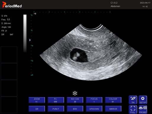   Trans-vaginal Probe-B Mode-Uterus 4