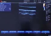   Linear Probe，B Mode，Carotid
