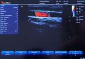   Linear Probe，Color Mode，Carotid