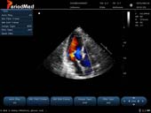   Phased Array Probe-Color Mode-Cardiac3