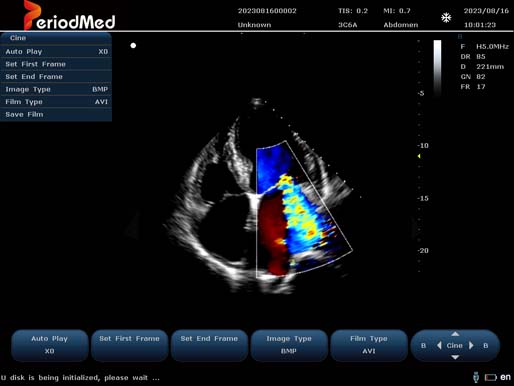  Phased Array Probe-Color Mode-Cardiac1