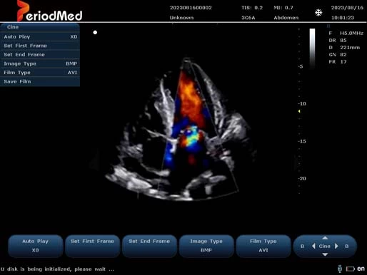  Phased Array Probe-Color Mode-Cardiac2