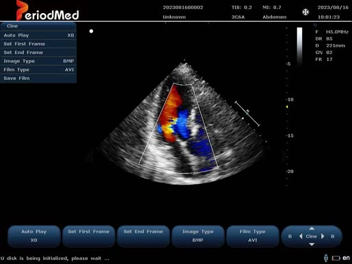  Phased Array Probe-Color Mode-Cardiac3