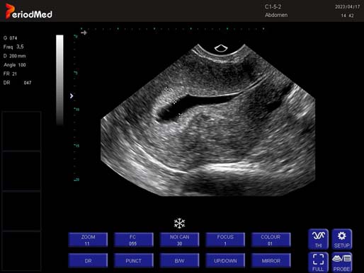  Trans-vaginal Probe-B Mode-Uterus 4