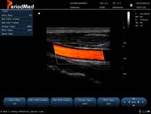   Linear Probe-Color Mode-Carotid3