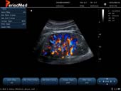  Convex Probe-Color Mode-Kidney 2