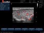  Linear Probe-Color Mode-THyroid1