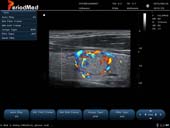  Linear Probe-Color Mode-THyroid2