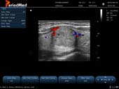  Linear Probe-Color Mode-THyroid3