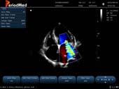  Phased Array Probe-Color Mode-Cardiac1