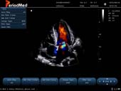  Phased Array Probe-Color Mode-Cardiac2