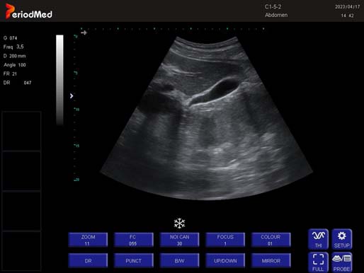 Convex Probe-B Mode-Gallbladder1