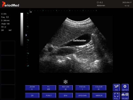 Convex Probe-B Mode-Gallbladder2