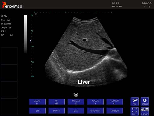 Convex Probe-B Mode-Liver3