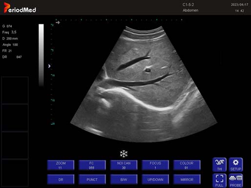Convex Probe-B Mode-Liver5