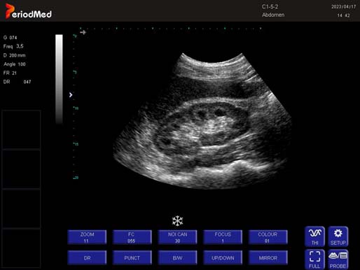 Convex Probe-B Mode-Kidney5