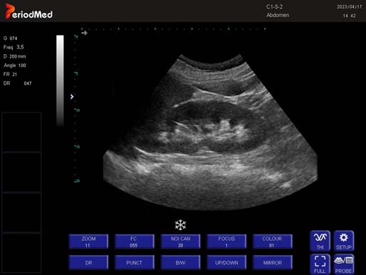 Convex Probe-B Mode-Kidney6