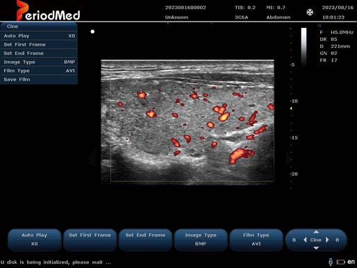 Linear Probe-Color Mode-THyroid1