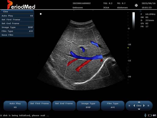  Convex Probe-Color Mode-Liver 3