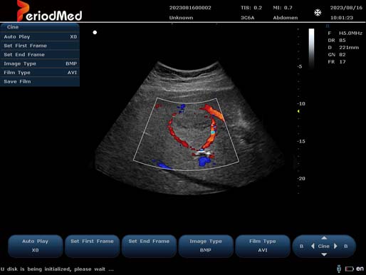  Convex Probe-Color Mode-Liver