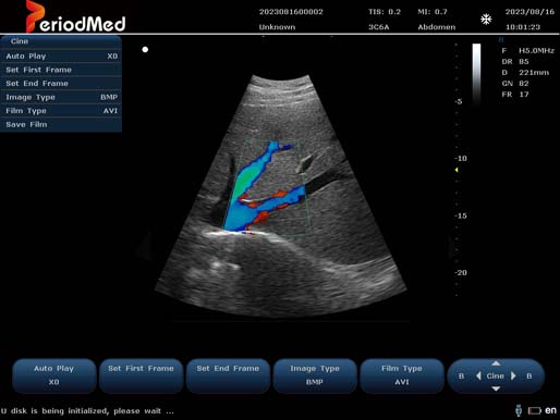  Convex Probe-Color Mode-Liver6