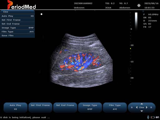  Convex Probe-Color Mode-Kidney 1