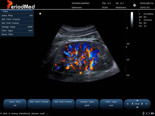  Convex Probe-Color Mode-Kidney 2