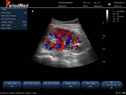  Convex Probe-Color Mode-Kidney4