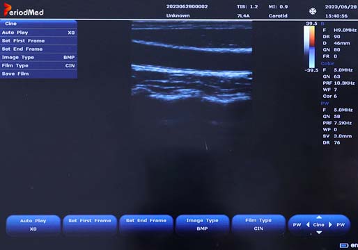  Linear Probe，B Mode，Carotid