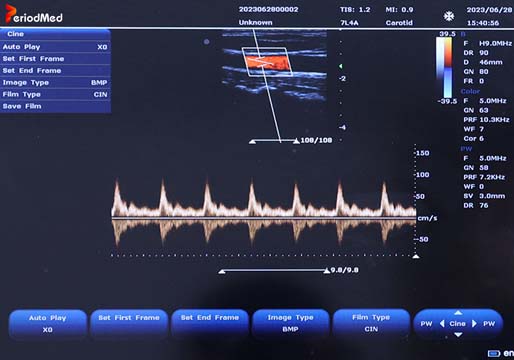  Linear Probe，PW Mode，Carotid