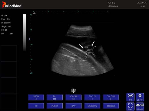 Convex Probe-B Mode-Uterus2 Dolphin