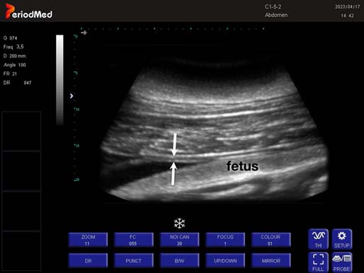 Convex Probe-B Mode-Uterus Dolphin