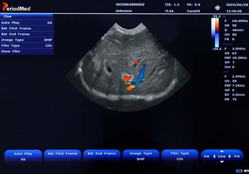  Micro-Convex Probe，Color Mode，Liver