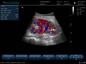 凸阵探头-彩色多普勒模式-肾脏 Convex Probe-Color Mode-Kidney4