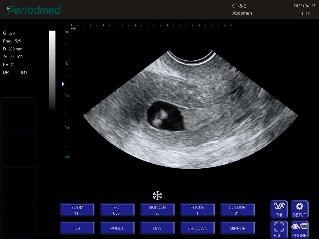 腔体探头-B模式-子宫 Trans-vaginal Probe-B Mode-Uterus 4