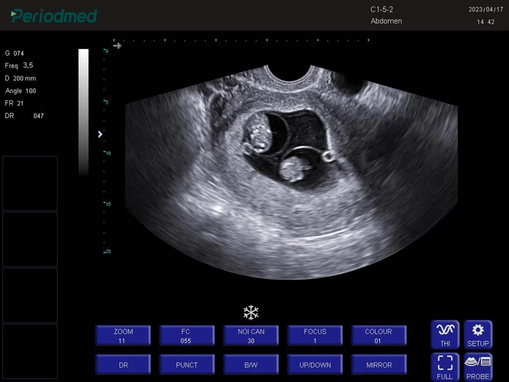 腔体探头-B模式-子宫 trans-vaginal probe-b mode-uterus 2