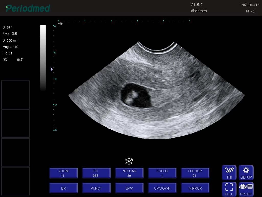 腔体探头-B模式-子宫 trans-vaginal probe-b mode-uterus 4