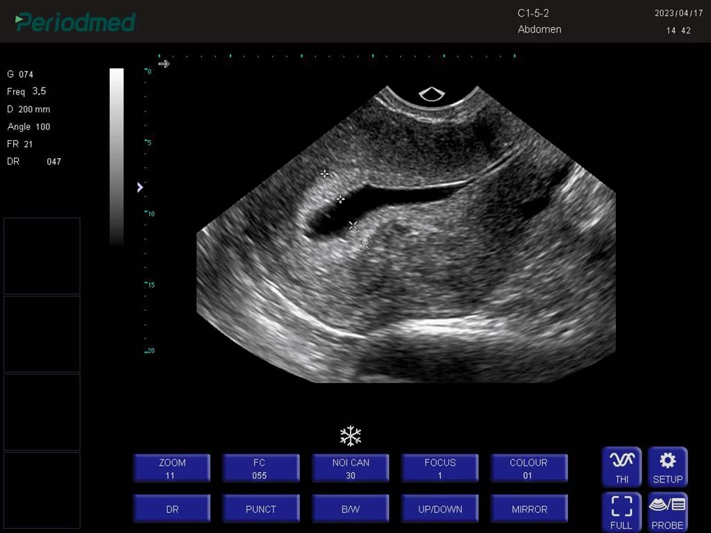 腔体探头-B模式-子宫 trans-vaginal probe-b mode-uterus 4