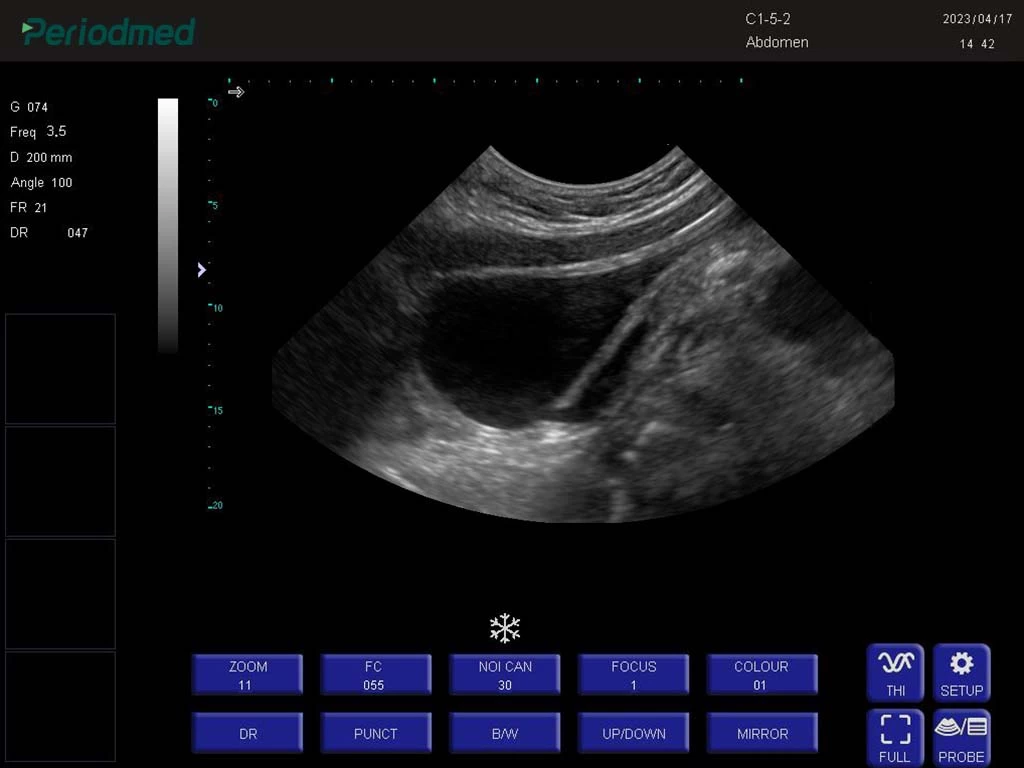 腔体探头-B模式-子宫 trans-vaginal probe-b mode-uterus1