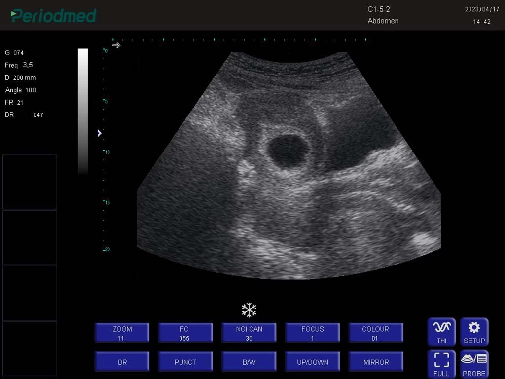腔体探头-B模式-子宫 trans-vaginal probe-b mode-uterus5