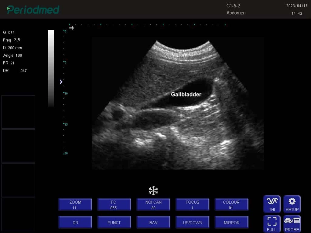 凸阵探头-B mode-胆囊 convex probe-b mode-gallbladder2