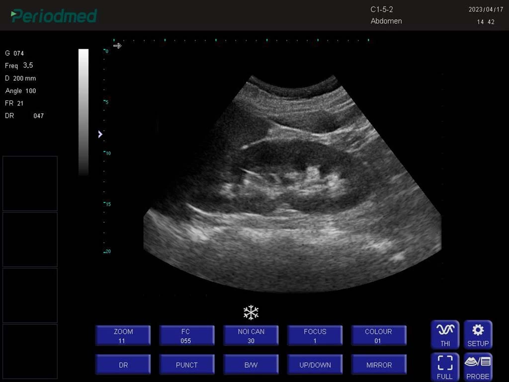 凸阵探头-B模式-肾脏 convex probe-b mode-kidney6