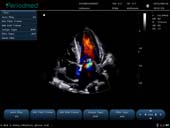 相控阵探头-彩色多普勒模式-心脏 Phased Array Probe-Color Mode-Cardiac2