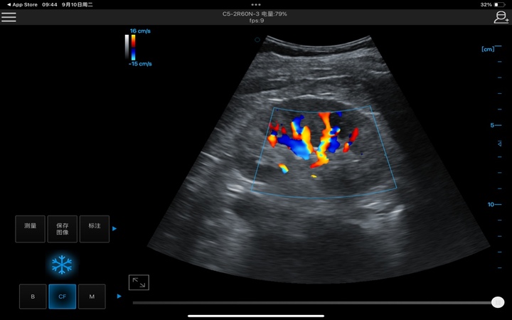 Kidney + CFM 肾脏+血流模式 1